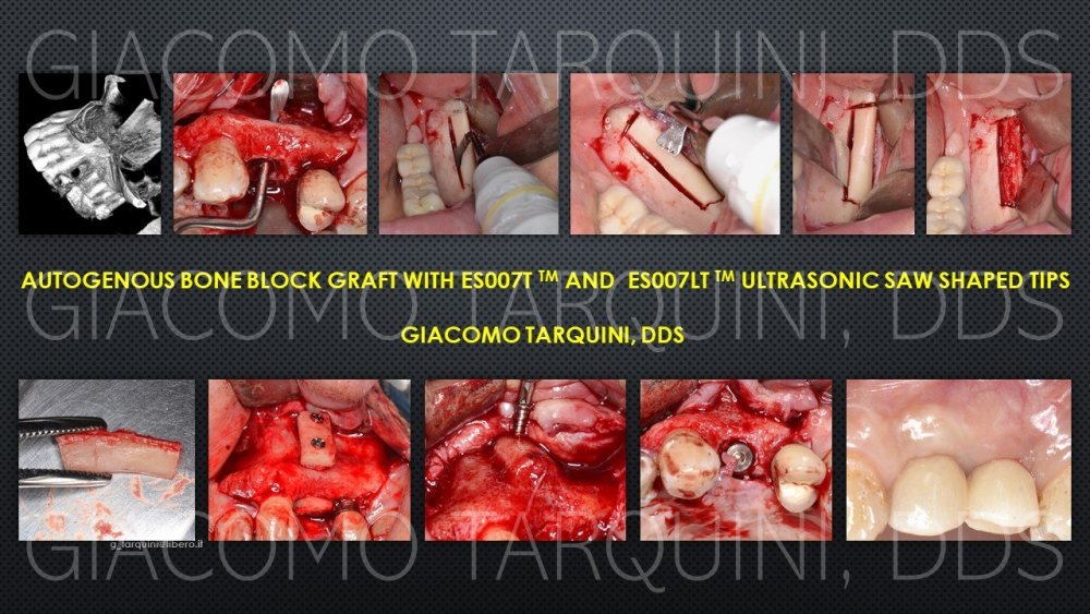 TARQUINI_BLOCK_GRAFT.thumb.jpg.28b1fc7fa0ff9deb206080d1fa327d6e.jpg