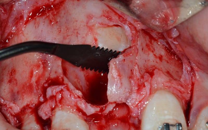 Videocorso: Chirurgia Piezoelettrica: Indicazioni E Limiti In Odontoiatria